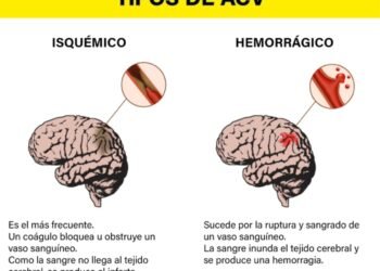 Comprendiendo el ACV Isquémico