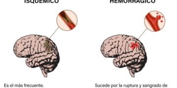 Comprendiendo el ACV Isquémico