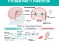 Desabastecimiento de medicamento para el Parkinson: opciones que considera el Gobierno para mitigar la crisis