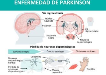 Desabastecimiento de medicamento para el Parkinson: opciones que considera el Gobierno para mitigar la crisis