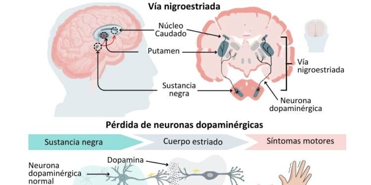 Desabastecimiento de medicamento para el Parkinson: opciones que considera el Gobierno para mitigar la crisis
